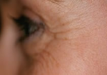 botox_crowsfeet_before